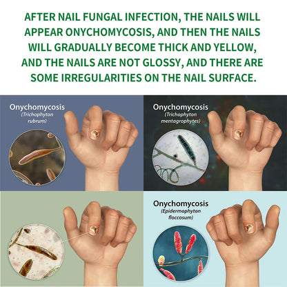 Toenail Nail Fungus Treatment Repair Fingernail Device Toenail Treatment for Foot Nail Fungus Essential Oil Onychomycosis Care