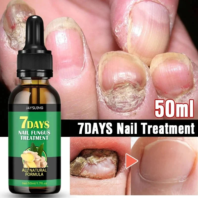 7 Days Nail Fungal Treatment Essence Oil Foot Toe Nail Fungus Removal Serum Repair Onychomycosi Anti Infection Gel Care Products