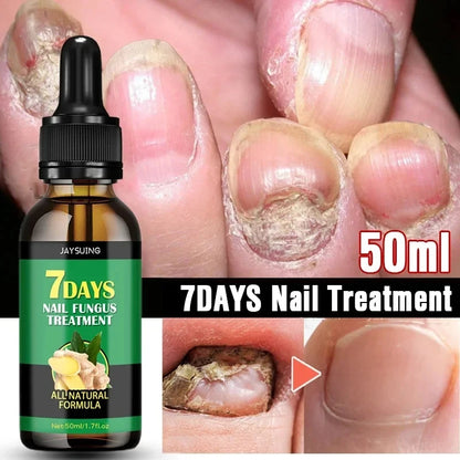 7 Days Nail Fungal Treatment Essence Oil Foot Toe Nail Fungus Removal Serum Repair Onychomycosi Anti Infection Gel Care Products