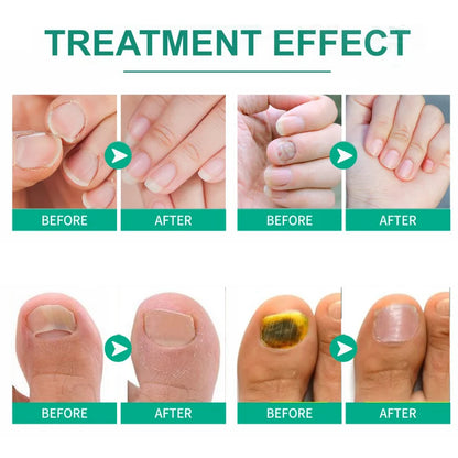 Extra Strong Nail Fungus Treatment Serum Essence oil Feet Nails Repair Care Essence Cream Anti Infection Toe Fungal Removal