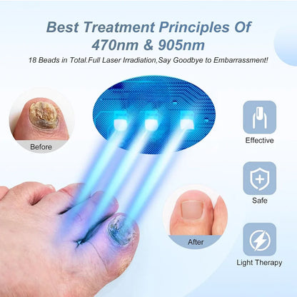 Fungal Nail Laser Device Repair Fast Nails Fungus Onychomycosis Repair Toenail Fingernail Removes Nail Fungus Foot Care