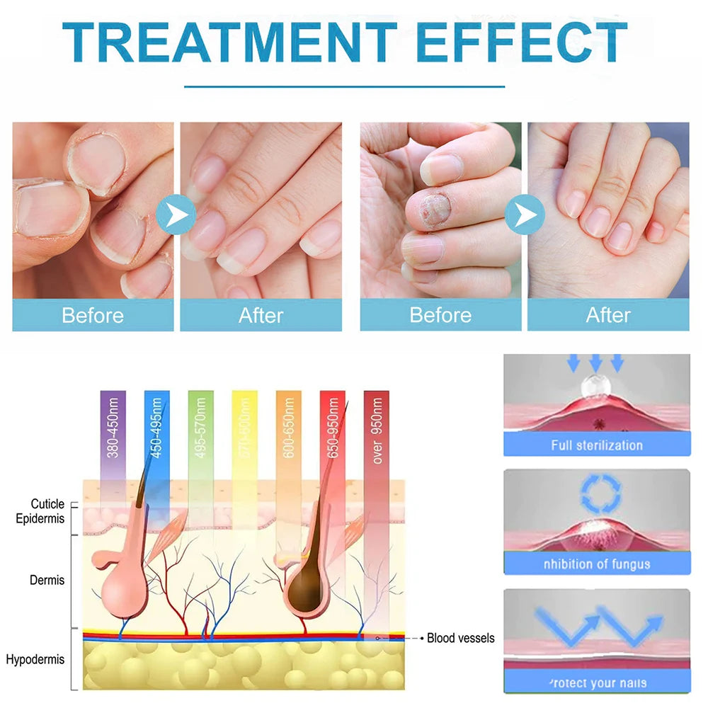 Toenail Nail Fungus Treatment Repair Fingernail Device Toenail Treatment for Foot Nail Fungus Essential Oil Onychomycosis Care